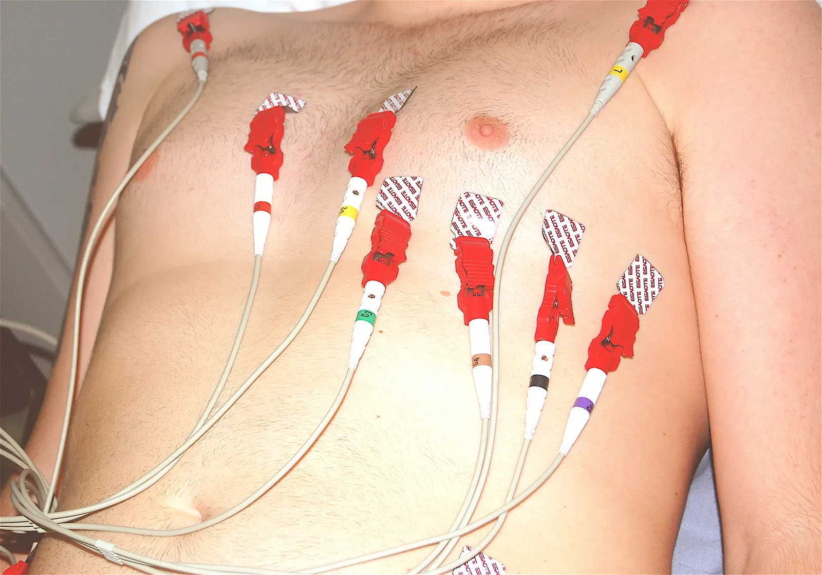 EKG